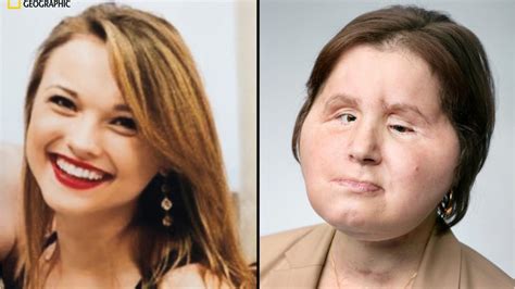 Face Transplant Gives Woman Second Chance Years After Suicide Attempt
