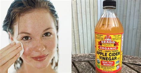Put Some Apple Cider Vinegar On Your Face And Watch The Magic Happen To