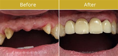 I feel that false teeth are real teeth, just not true (i.e. Dental Bridges Hammersmith - Kings Dental Clinic