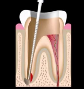 How long after root canal do they do the crown? Root canal treatment - Emergency, Cost, Crown - Frisco, TX ...