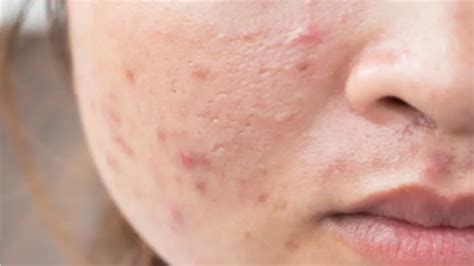 How To Get Rid Of Fungal Acne On Face Home Remedies Youtube