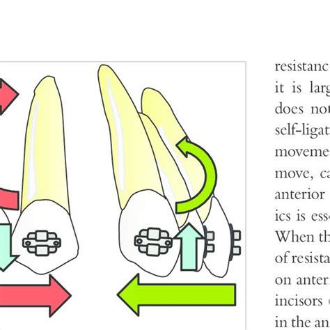 Types Of Tooth Movement A Uncontrolled Tipping B Controlled