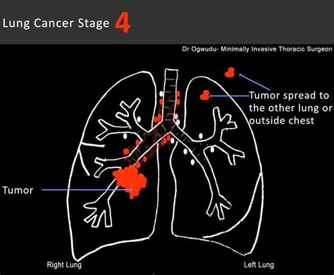 The final stage, or the stage 4 lung cancer is an irreversible condition, where the cancerous cells have spread to other healthy organs in the body. Lung Cancer: Lung Cancer Life Expectancy