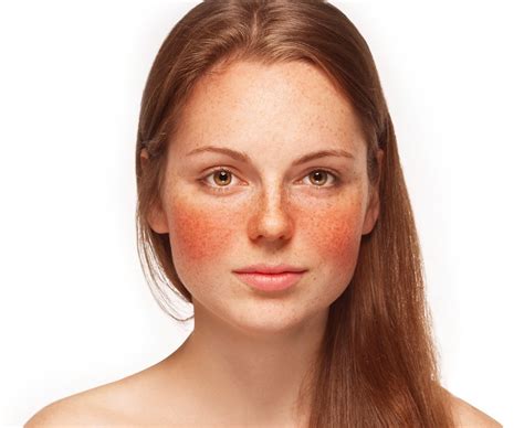 Rosacea Vs Acne What Is The Difference Dermapenworld