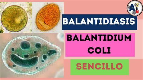 Balantidiasis Balantidium Coli ExplicaciÓn Resumida Youtube