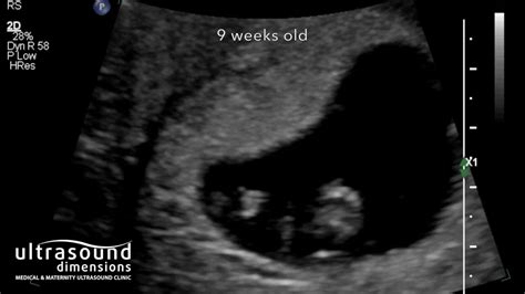 9 Weeks Pregnant 3d Ultrasound