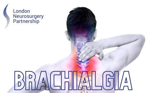 Brachialgia London Neurosurgery Spine And Neurosurgery