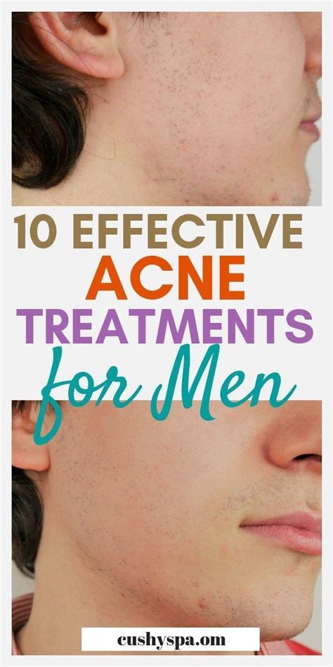 Acne Treatment Cream Cystic Acne Treatment Homemade Acne Treatment