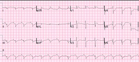 Ecg &cardiac arrestcardiac arrestcpr aha changes. Dr. Smith's ECG Blog: ST depression after cardiac arrest ...