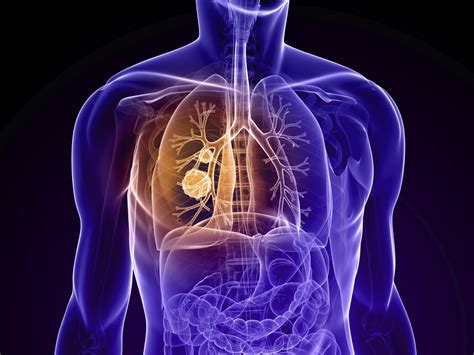 To analyse frequency, characteristics and patient survival with lung cancer (lc) and copd, comparing them with patients without copd. FAQ: About Stem Cell COPD Treatment | NSI Stem Cell