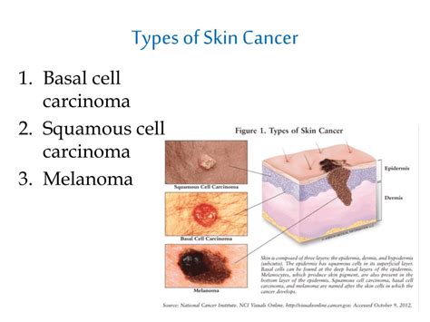 Ppt Skin Cancer Powerpoint Presentation Free Download Id1861868