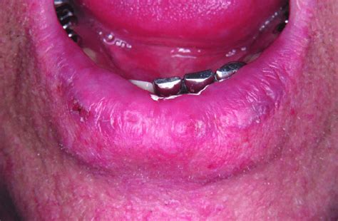 Actinic Cheilitis Affecting The Lower Lip Download Scientific Diagram