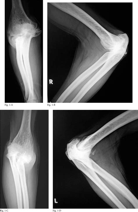 Figure 1 From Compressive Ulnar Neuropathy Due To A Ganglion Cyst And