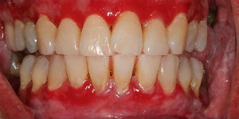 Gingivitis Causes Signs Symptoms How To Get Rid Of Gingivitis
