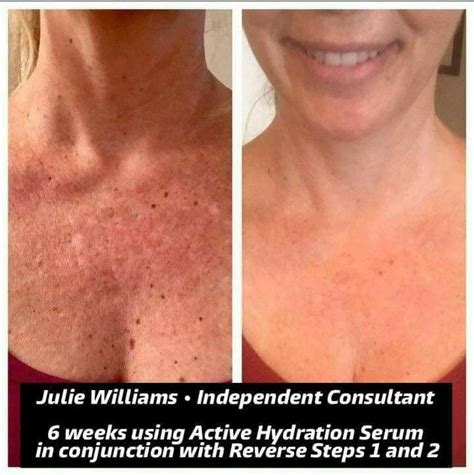 Do You Have Stubborn Dark Spots Or Sun Damage That Wont Go Away Give