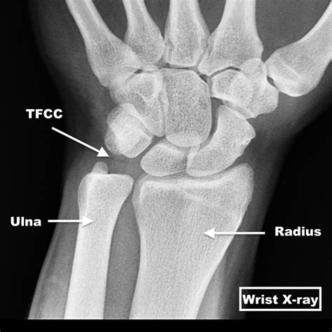 Tfcc Wrist Cartilage Tear
