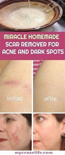 The good news is that these basic home remedies for acne, which are easy to make and apply, can be tried easily for an effective spot treatment to shrink a pimple. DIY Homemade Acne Scar Remover Guide #bestskincare in 2020 ...