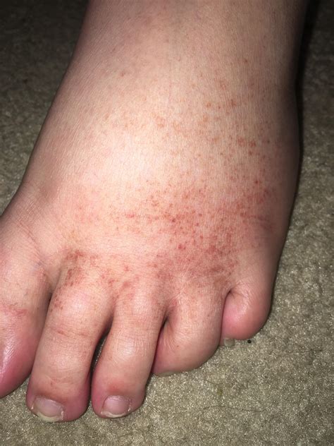 My Brother 14yo Told Me These Spots Have Been Appearing Over The Last