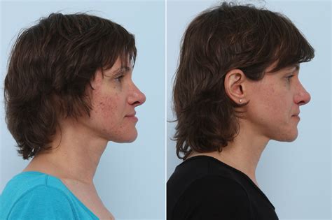 Chemical Peels Photos Houston Tx Patient 10226