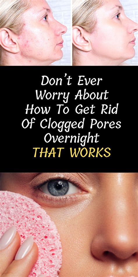 Dont Ever Worry About How To Get Rid Of Clogged Pores Overnight Nas