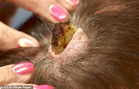 Woman Who Has Ten Large Cysts On Her Scalp Gets Them Removed In Dr