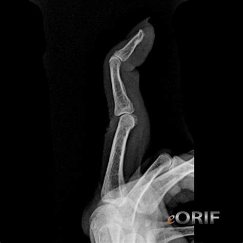 Swan Neck Deformity M20.039 736.22 | eORIF