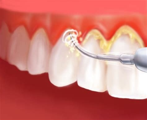 Dental plaque is almost invisible except if it is stained. Remedies To Remove Tartar And Plaque Build Up On Teeth ...