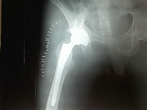 Clinical Images Total Hip Replacement