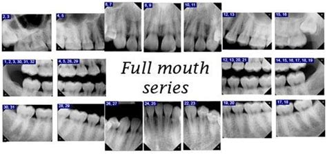 Full Mouth Dental X Rays Full Mouth Series It Consists Of 18