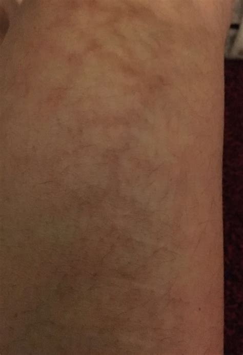 Ask A Dermatologist Online For Have Red Lines On My Legs