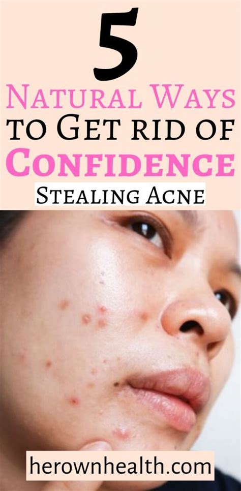 As you can see in the drawings, when this happens the hollowness under the eyes (tear trough) gets deeper and the nasolabial lines become more visible. 5 Natural Ways to Get rid of Confidence - Stealing Acne ...