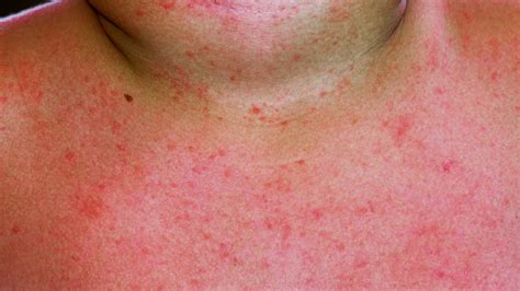What You Should Do If You Have A Heat Rash