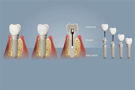 Piezas Que Componen Un Implante Dental Clínica Dental Seoane Pampín