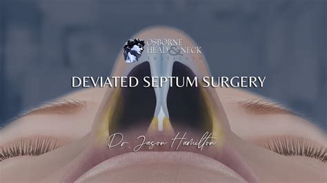Deviated Septum Surgery Youtube