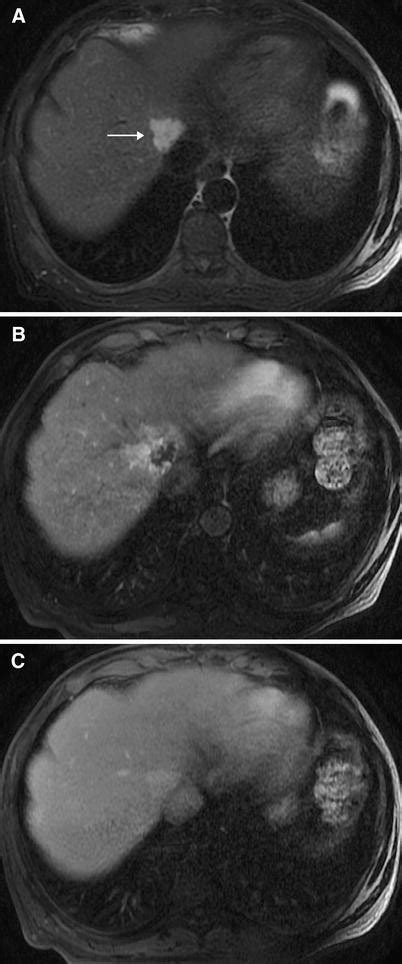 Perilesional Enhancement Of Liver Cavernous Hemangiomas In Magnetic