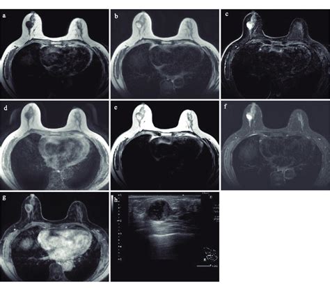 Case 1 Of Sy Mri And Conventional Mri In The Breast A 69 Year Old