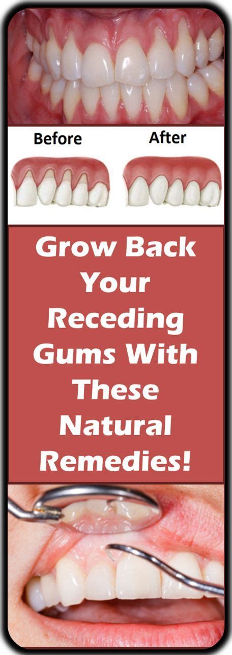 Grow Back Your Receding Gums With These Natural Remedies With