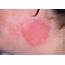 Urticaria Evaluation And Treatment  American Family Physician