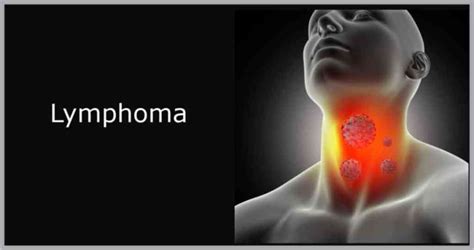 How Fast Can You Die From Lymphoma All About Lymphoma