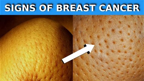 Warning Signs Of Breast Cancer You Shouldn T Ignore Youtube