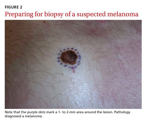 Biopsies For Skin Cancer Detection Dispelling The Myths Clinician