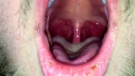 Swollen Throat Diagnosis Youtube