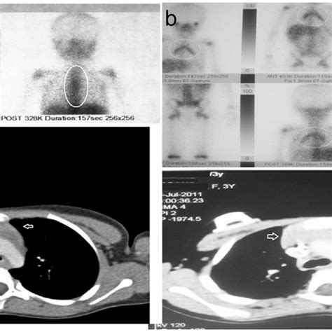 A And B Ct And Ga 67 Scan Images Of Two Rebound Thymic Hyperplasia