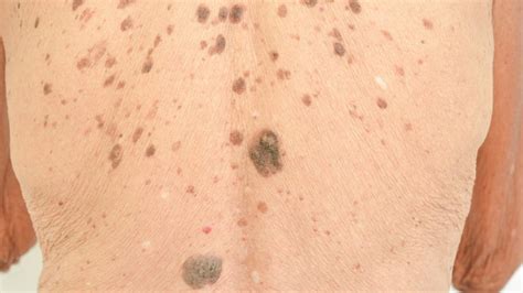 Liver Spots On Body