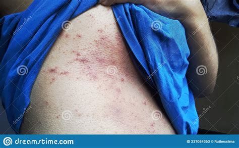 Skin Disease Atopic Dermatitis Stock Image Image Of Frames Future