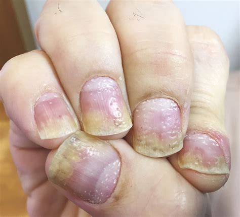 This Mans Pitted Nails Turned Out To Be Psoriasis