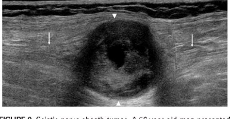 Figure 9 From Sonographic Examination Of The Buttock Semantic Scholar
