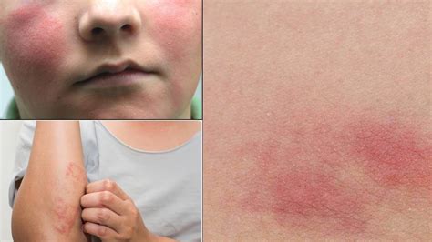 What Are Rashes And How To Get Rid Of Rashes Treatments The Rashes