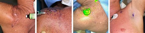 Atypical Fibroxanthoma Afx Skin Cancer And Reconstructive Surgery