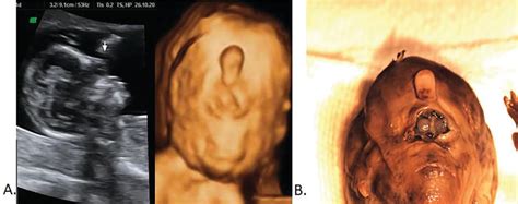 Congenital Abnormalities Of The Fetal Face Intechopen